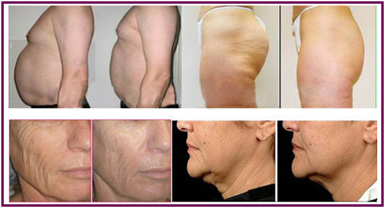 3 Tips RF Skin Tightening Machine / Radio Frequency Machine For Skin Tightening