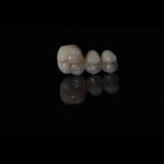 Anti Wear Implant PFM Dental Bridge Prosthesis Teeth Replacement
