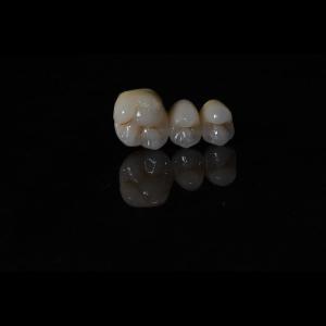 Quality Anti Wear Implant PFM Dental Bridge Prosthesis Teeth Replacement wholesale