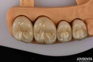 Quality Premium Gold and Palladium Alloy Dental Crowns for Enhanced Durability wholesale