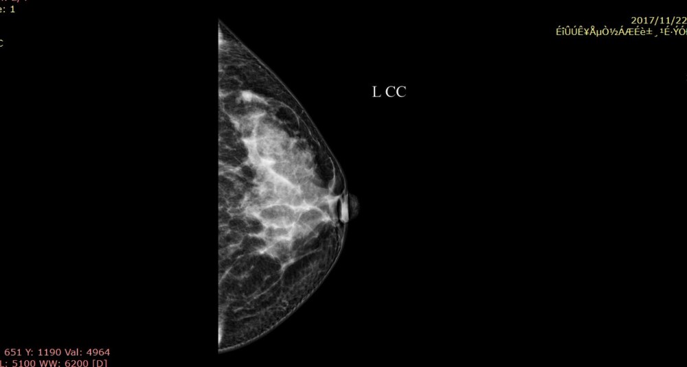 Full Digital Mammography System with Panel Detector for Sales