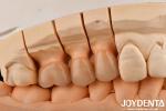 High Chipping Resistance And Natural-looking Esthetics With Multilayer Full