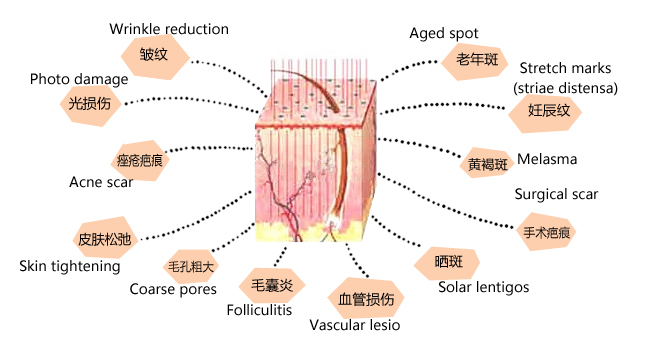 co2 laser treatment.jpg