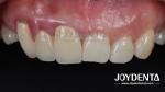Painless Procedure BOPT Dental Technique for Accurate Tooth Preparation
