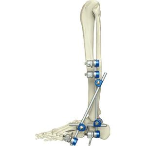 Quality Medical Orthopedic Instrument Ankle External Fixation Device wholesale