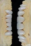 Long-lasting And Stain Resistant Dental Veneers With Personalized Shades For