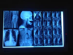 Quality Low Fog Medical Dry Imaging Film For AGFA5300 / Fuji3000 14 x 17inch wholesale