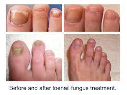 15 Watts Podiatry Laser 810nm 980nm Toenail Fungus Removal Laser