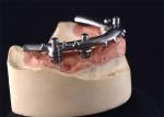 High-Density PFM Dental Implants Dentures Strong Hardness Long Lasting​