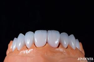 Quality 0.3-0.5mm Thickness Emax Porcelain Veneer for High Gloss Cosmetic Dentistry wholesale