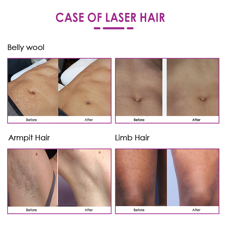 Portable Multifunction 808nm Diode Laser Hair Removal Beauty Machine And Skin Resurfacing