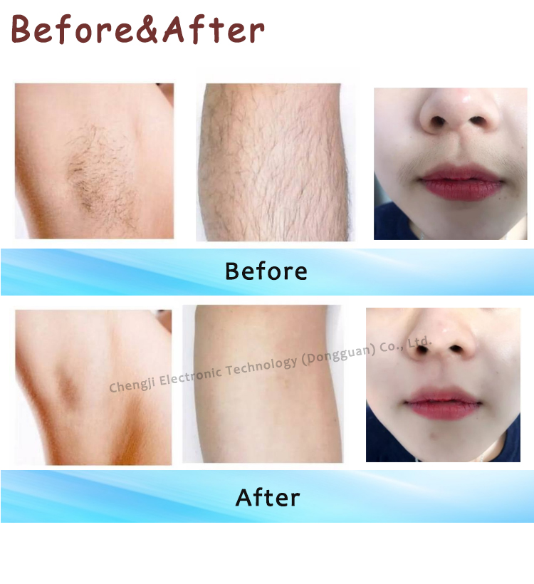 Lightsheer Diode Laser Hair Removal Machine 755nm Laser Machine For Skin Rejuvenation