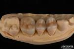 Natural Looking Emax Inlay Onlay Long Lasting Dental Restoration 0.5mm 1mm 1.5mm