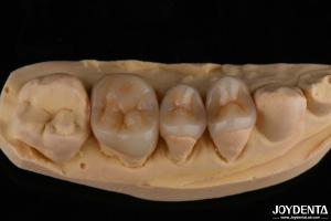 Quality Natural Looking Emax Inlay Onlay Long Lasting Dental Restoration 0.5mm 1mm 1.5mm Thick wholesale