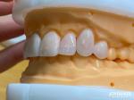 Lightweight and Smooth Dental Veneers Stain Resistance Long-lasting Durability