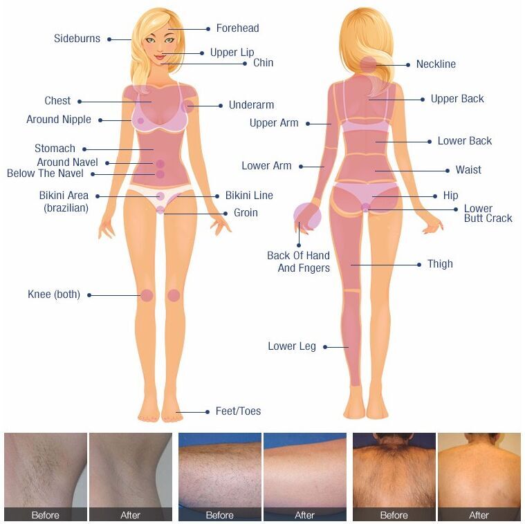 755 808 Laser Hair Removal Machine Permanent 1064 SHR OPT IPL Epilation Definitive