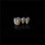 Anti Wear Implant PFM Dental Bridge Prosthesis Teeth Replacement