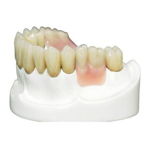Quality MK1 Precision Attachment Denture for Perfect Fit and Protection wholesale