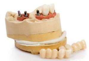 Quality Customized Dental Implant Replacement Durable Titanium Dental Implant wholesale