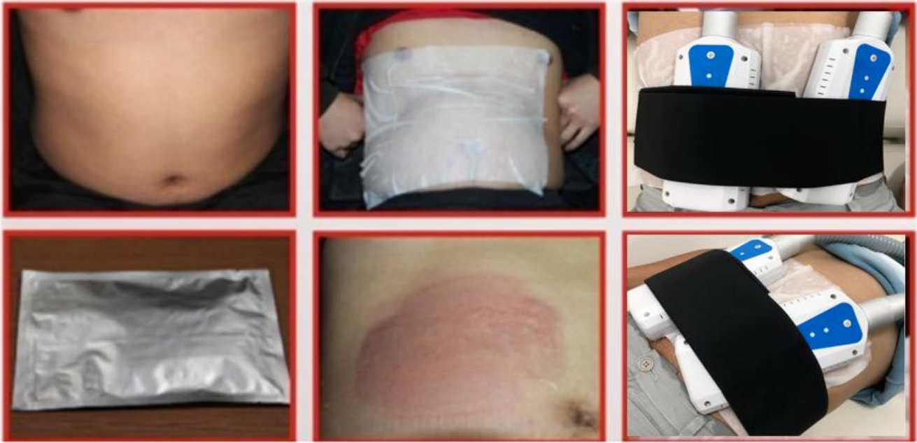 Portable fat freezing machine cryo skin cryo pads slim machine for body slimming