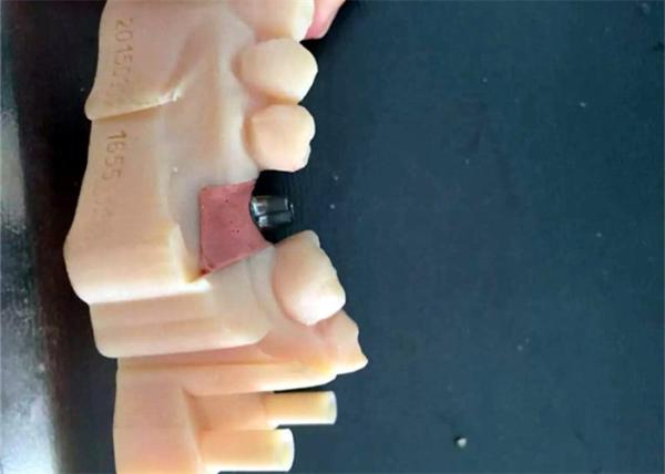 CAD / CAM PFM Dental Crowns Bridge Resin Material Good Biocompatibility