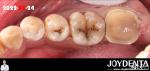 Natural Color Accurate Fit Dental Inlay For Damaged Teeth Restoration