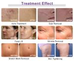 Portable Gold Micro Needle Equipment Radio Frequency Face Lift Fractional RF