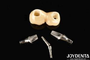 Quality Experience Aesthetically Pleasing Results With Customizable Implant Retained Crown And Bridge wholesale