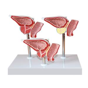 Quality Human Anatomy PVC Simulation Human Pathology Prostate Model For Medical Educational wholesale
