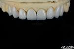 Glossy Surface Texture Feldspathic Veneer Natural Looking Porcelain Veneer