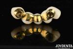 Excellent Strength Ti-Bar Zirconia Hybrid Bridge For Natural Teeth And Gums