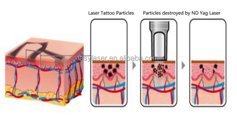 Nanosecond Portable Nd Yag Laser Tattoo Removal Machine 1064nm