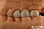 High Strength Dental Zirconia Your Ultimate Solution For Natural-looking