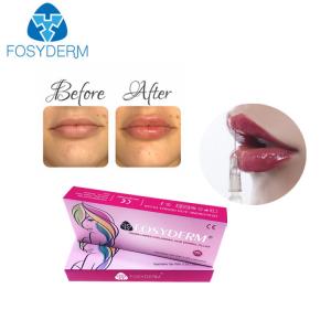 Quality 1ml hyaluronic acid lip fillers Derm Lip Enhancement Injection For Women wholesale