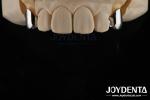 Precision Removable Prosthesis Dental Implant Attachments Easy Clean Comfortable