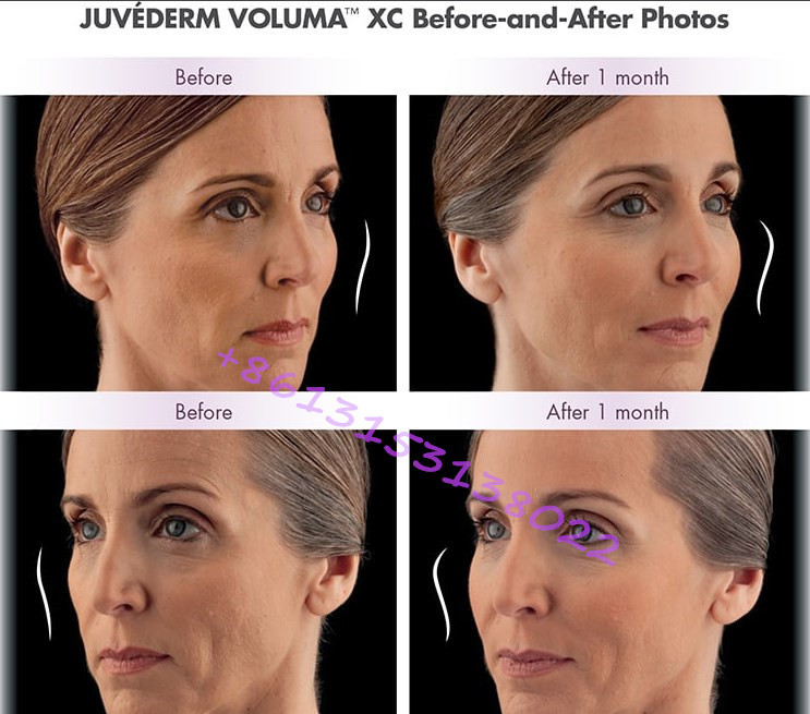 Long Lasting Hyaluronic Acid Facial Filler Juvederm Voluma Cheek Filler