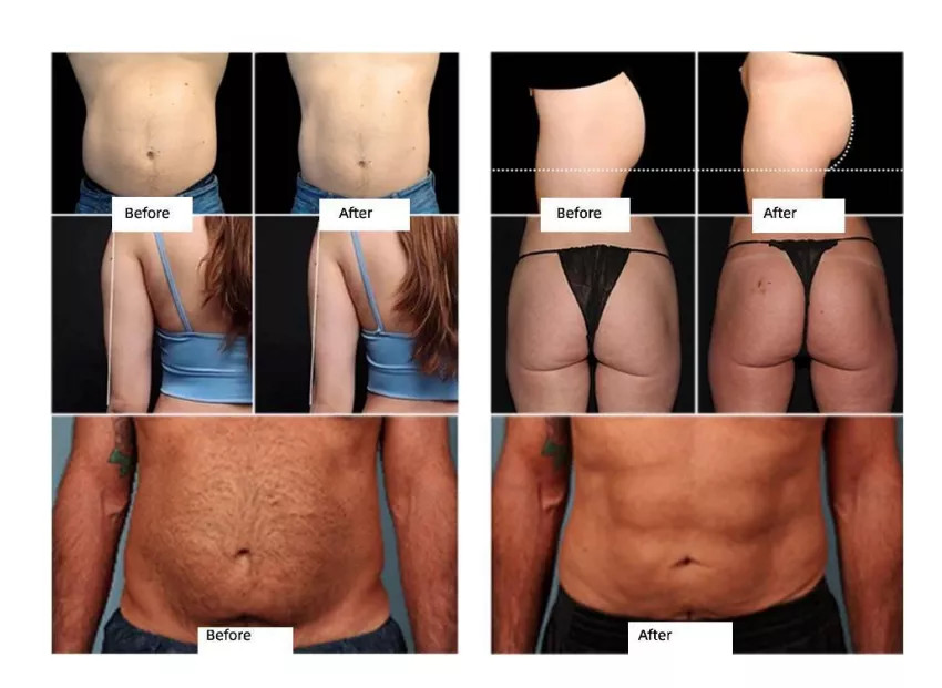 Black Slimming Beauty Machine 3000W Ems Muscle Build Body Contouring Dual Handles