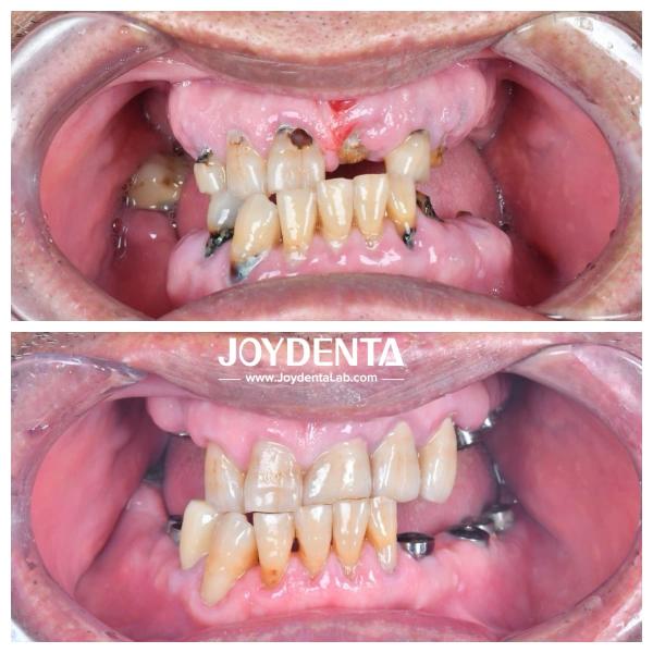 Resistant To Wear And Deformation Zirconia Dental Crowns Durable and Suitable