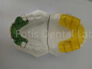Quality Convenient Hygienic Orthodontist Palate Expander Teeth Retainer wholesale