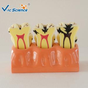 Quality Decayed Tooth Orthodontic Study Models 4 Times Caries Disassembling Model wholesale
