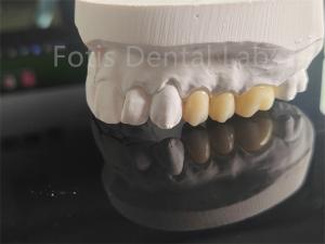 Quality High Strength Full Porcelain Layered Zirconia For Dental Crowns wholesale