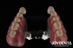 Precision Removable Prosthesis Dental Implant Attachments Easy Clean Comfortable