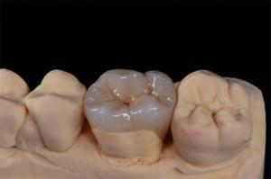 Quality Minimally Invasive Zirconia Crown for Natural Smile Design wholesale