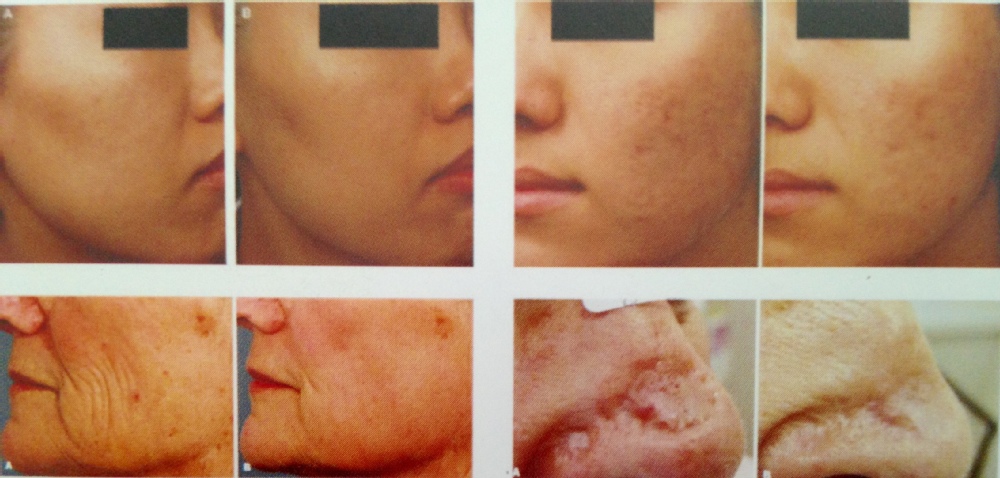 Rf Tube Vaginal Tightening Fractional Co2 Laser Machine 0.1 - 2.6mm Spot Distance