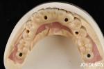 Durable Dental Aesthetic Titanium Malong Hybrid Bridge For Care