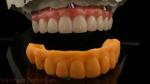 5 Year Guarantee Dental Implant Crown PMMA Bridge Over Multi Unit Abutments