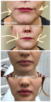 HA Cross Linked Hyaluronic Acid Wrinkle Fillers Injections For Deep Face Wrinkles