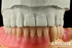 Stainless Steel Prostheses Partial Dentures Attachments Polished Surface Ball