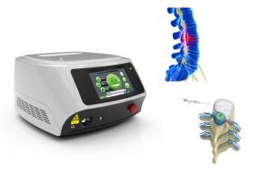 Quality Painless Percutaneous Laser Disk Decompression Cherylas 1470nm wholesale
