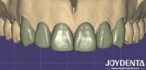 Quality 3D Printing Virtual Digital Wax Up Seamless Compatibility With Other Dental Software wholesale